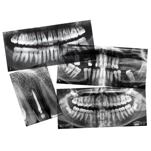 Dental X-Rays - 15pcs